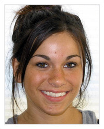 short term orthodontics